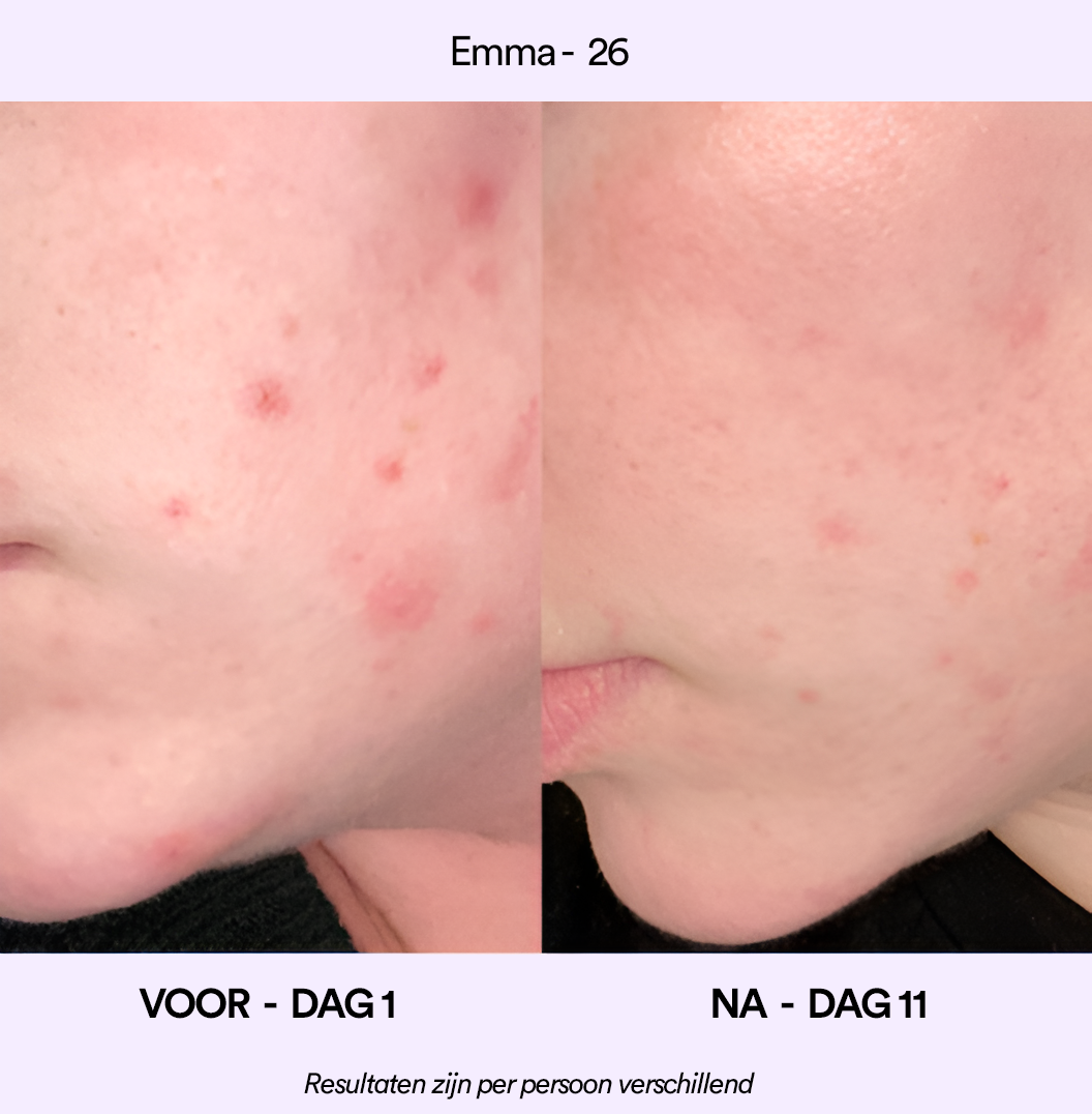 Spotlyte: 3 minuten durende behandeling van puistjes