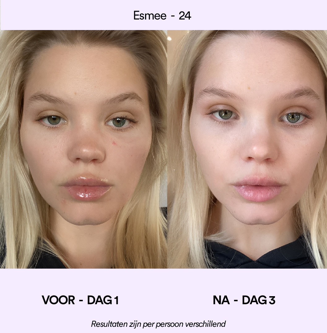 Spotlyte: 3 minuten durende behandeling van puistjes
