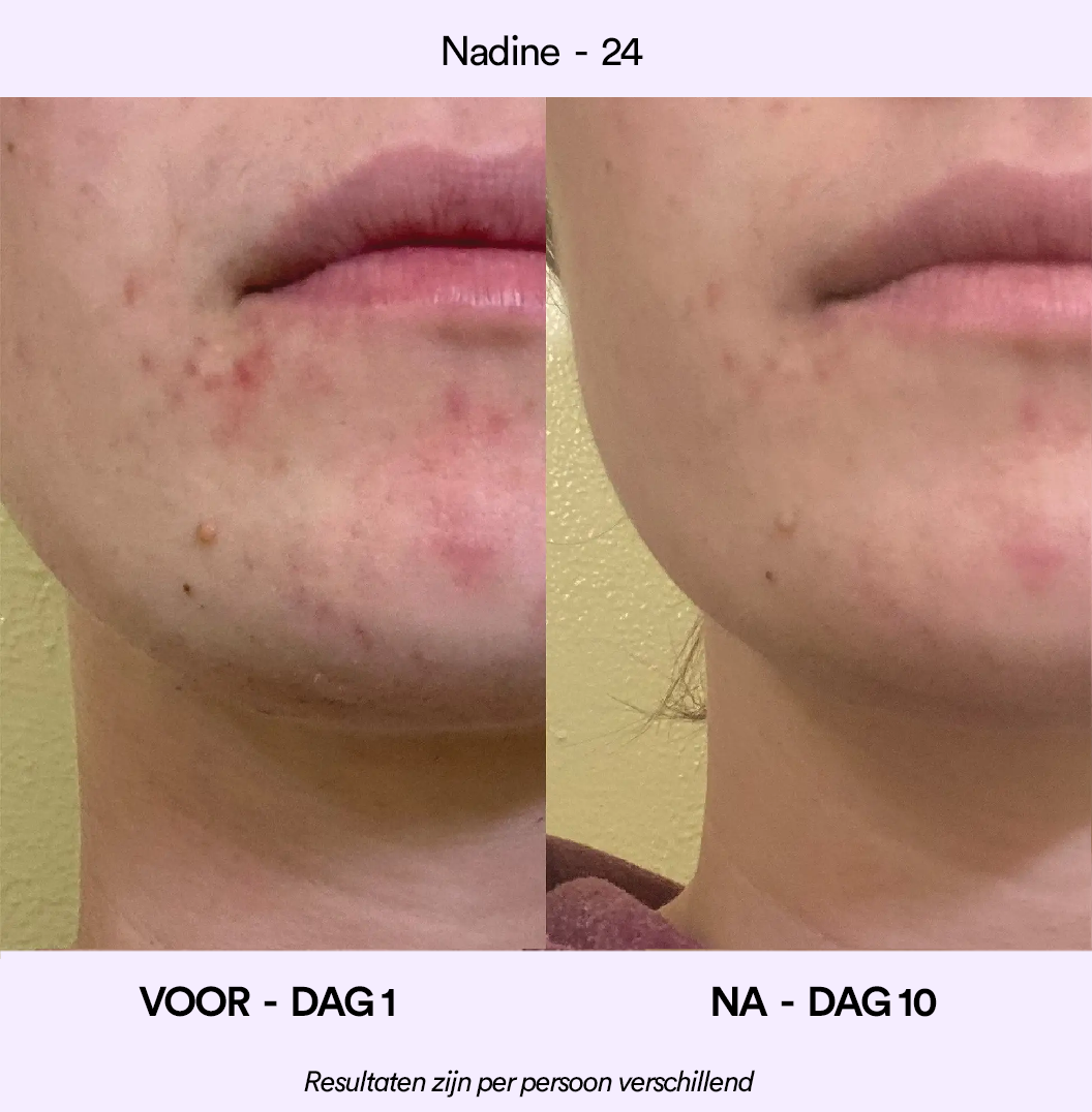 Spotlyte: 3 minuten durende behandeling van puistjes