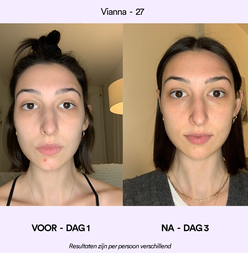 Spotlyte: 3 minuten durende behandeling van puistjes